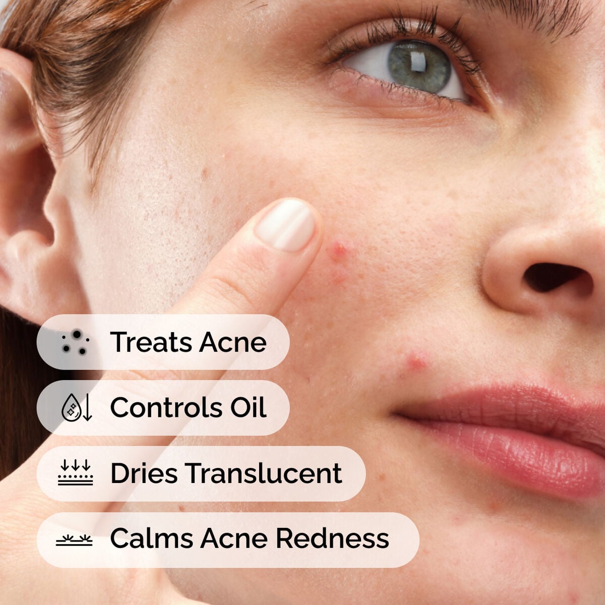 sulfur-10-powder-to-cream-concentrate-c4 ord-sulfur-10pct-powder-to-cream-concentrate-model-application-with-benefits-acne.jpg