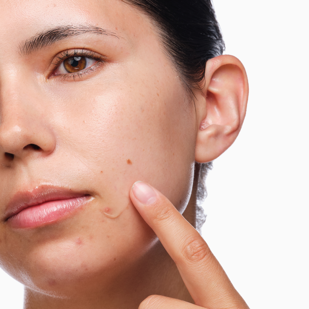 the-acne-set-u1 rdn-the-acne-set-application.png